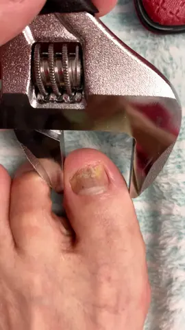 Ok,bye nail fungus #nail #fyp #nailcare #yellownails #nailfungus #toenails #nailtok #tiktokshop 
