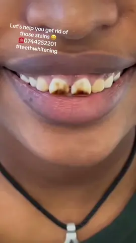 Teeth whitening contact  Precision dental clinic Kampala on 0744252201