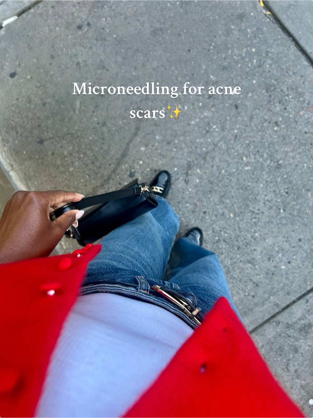 Come with me to my microneedling appt✨ Helps with acne scars, texture and that overall glow - invest in your skin ladies💕 @ZARA @ALDO Shoes #SelfCare #microneedling #facialtreatments #beautytips #blackgirlskincare 