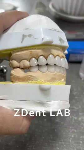 #ZDentLab #DentalCrowns #CrownAndBridge #CosmeticDentistry #AnteriorEsthetics