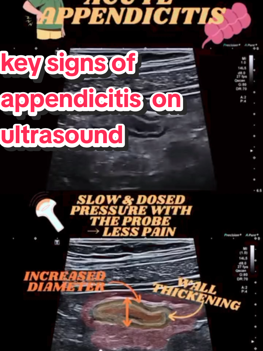 key signs of appendicitis on ultrasound#appendicitis #acuteappendicitis #ultrasound #fyp #viralvideo 