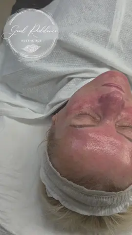 #CapCut #glassskin #glowingskin #microneedling #prp #chemicalpeel #acnefighter #finelinesandwrinkles #fyp #carbonpeel #biorepeel #skinbooster #carboxytherapy #hydrafacial #polynucleotides  #rf #rfmicroneedling #stneots 