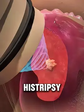 Histotripsy 🔊🩺 | Surgery Without Cutting? #histotripsy #focusedultrasound #noninvasivesurgery #medical3danimation #medicalanimation 