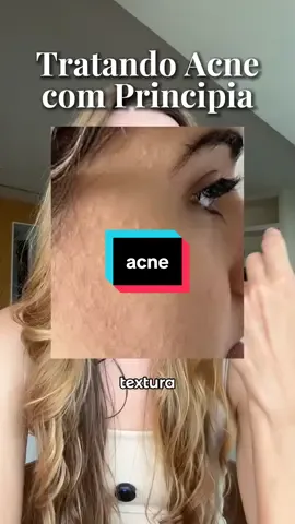 Produtos citados no vídeo: O AL-7, o Mix 01 e o Rn 0,3. Todos da @PRINCIPIA  Cupons  MARINACRISTOFANI5 5% de desconto (para compras de 2 produtos) MARINACRISTOFANI10 10% de desconto (para compras de 3 ou mais produtos) #principia #acne #cuidadoscomapele #marinafarmaceutica parceria paga