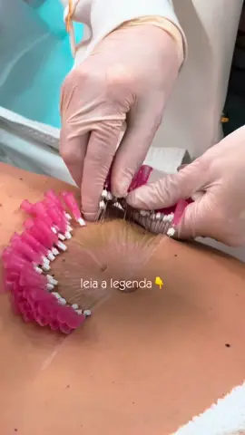Você já ouviu falar em “umbigo triste”? 👇 Esse é um dos sinais da flacidez abdominal, muito comum no pós-parto ou após grandes perdas de peso. No GTC, tratamos esse quadro com uma abordagem combinada: fios de PDO para sustentar e estimular colágeno + radiofrequência monopolar, que atua na retração e firmeza da pele.  O resultado? Redefinição da região, melhora da textura e um abdômen mais harmonioso, sem exageros, com ciência aplicada e naturalidade. Ficou curiosa para saber se esse protocolo pode ser para você? Envie uma mensagem para nossa equipe. #gtcgroup #quietbeauty #flacidez #pdo #radiofrequencia