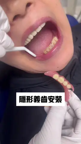 #微笑牙 #牙齒 #牙貼片 ##微笑牙 #牙齒 #牙貼片 #全瓷牙 #牙齒美白 #牙齒矯正 #全瓷貼片 #全瓷冠#種植牙