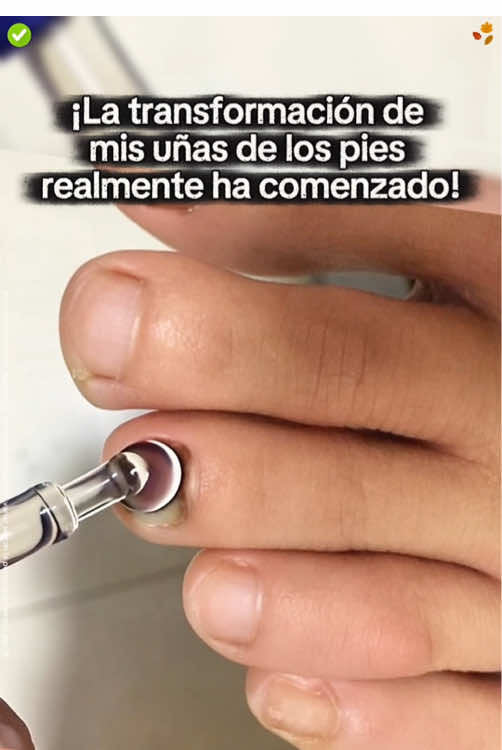 ¿Uñas feas? Puede que no sea un problema tan pequeño...#nailcare #toenails #nails #tiktokshop #foryou 