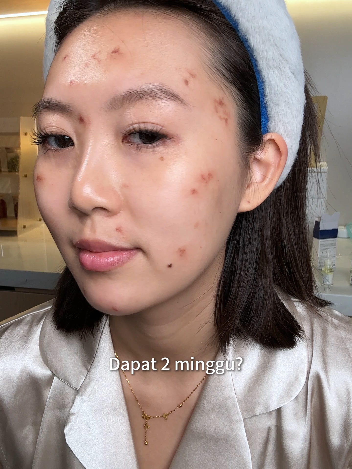 Salicylic Acid Acne Treatment, penghapus jerawat. Grab sekarang dalam Live Dr Leo sekarang!