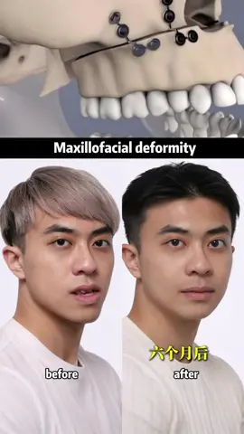 #反差 #磨骨 #磨骨手术 #下颌角 #faceshape #调整脸型 #bone #smallface #jawline 