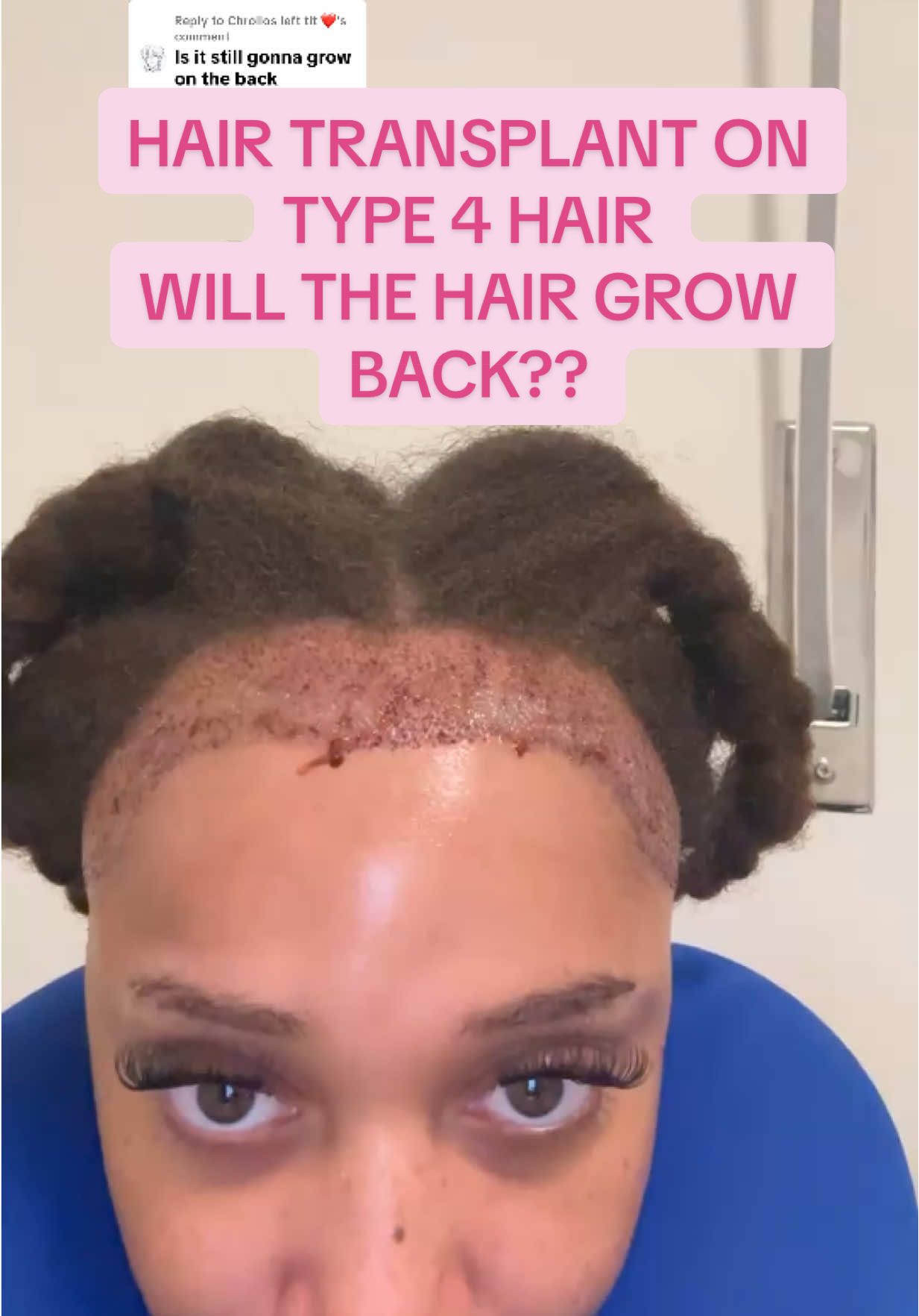 Replying to @Chrollos left tit ❤️  the ones that were extracted will grow where they get placed at as long as your doing what your doctors recommend and take good care of it #naturalhair #type4hair #hairtransplant #naturalhairtiktok #hairgrowthjourney 