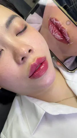 Cam thường nói không với chỉnh sửa môi siêu nét tại Tera kỹ thuật độc quyền Dlowslipsver2 #moithietke #moibaby #tiemmoifiller #fillermoi #xuhuongtiktok 