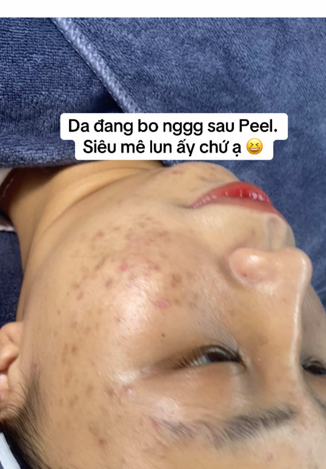 Da đẹp lên từng này lunnn ạ 🥰 khách iiu da đang tăng sắc tố sau mụn thì ib Jinn ngay nè #nanmunchuanykhoa #JinnAcne #nanmuntaininhbinh #chamsocdataininhbinh 