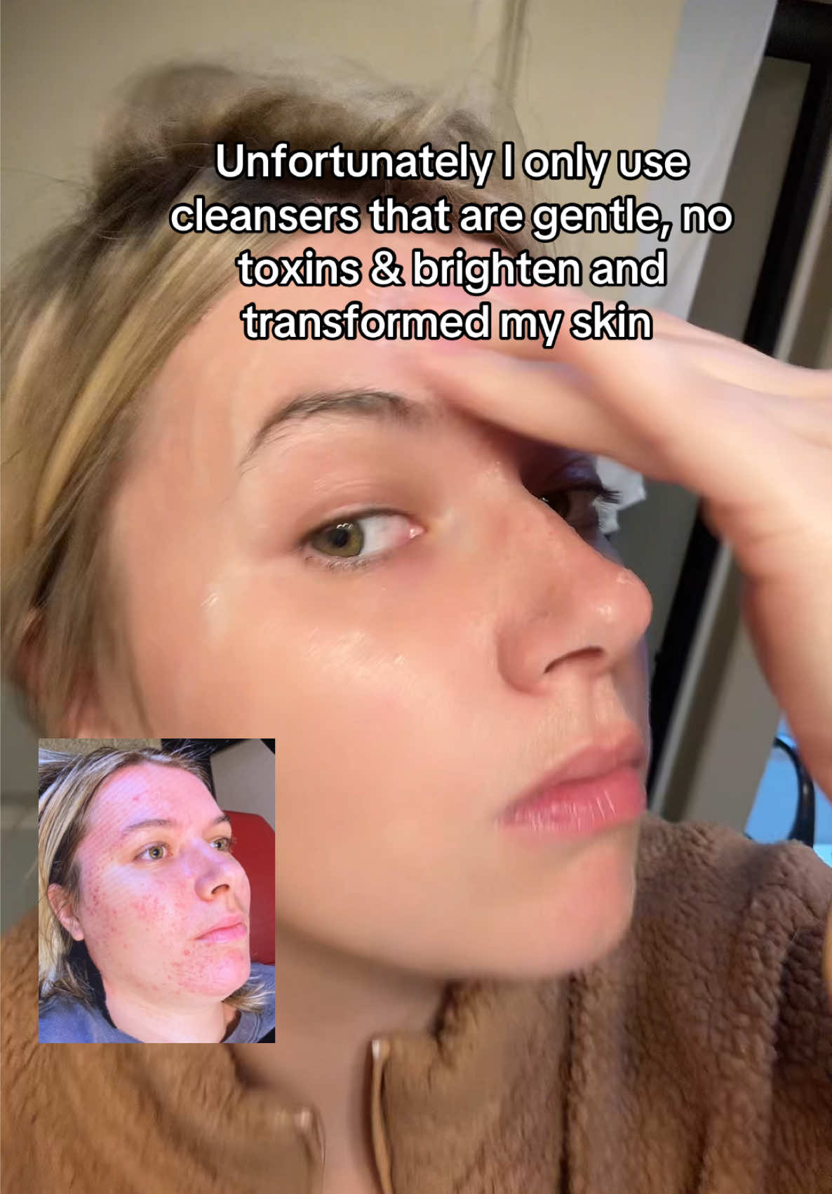 The absolute best cleanser! #clearstem #holisticskincare #breakouts #skinbarrier #sensitiveskin 