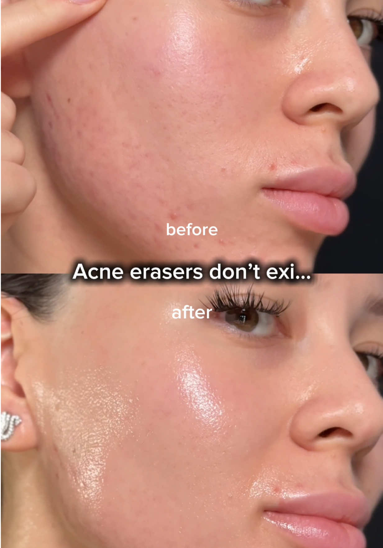 Acne eraser 🌿 LEMONGRASS NIACINAMIDE 20 SERUM Keeps my skin clear and fresh ✨ @skinfood_global @SKINFOOD US Store  #skinfood#niacinamide#acnecare#darkspotcare#tiktokmademebuyit 