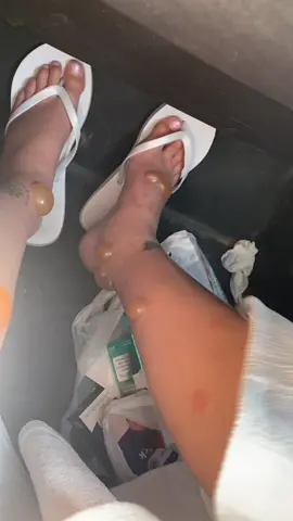 Happy honeymoon, got to say with my luck this actually didn’t even suprise me. Insane reaction to insect bites. Still had a blast even if I struggled walking 😂