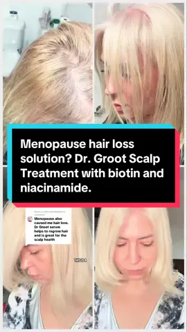 Replying to @Marcela Madeira  Menopause was thinning my hair… until I found the Dr. Groot Scalp Treatment Set 🌱 I start with the Dr. Groot Spray to hydrate, soothe, and prep my scalp, then apply the Roll-On Serum that instantly cools and reduces excess oil by 46%. With biotin, rosemary, niacinamide, and caffeine, it’s reduced my shedding, made my scalp healthier, and helped my hair look fuller and stronger. I apply it twice a day, every day — and the results are real. If you’re dealing with hair loss, thinning, or scalp issues from menopause, this is the solution. And it’s on SALE now.  #D#DrGrootD#DrGrootScalpTreatmentD#DrGrootScalpSpraymenopausehairloss  ##HairLossTreatment