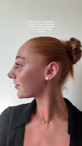 i sobbed and sobbed (excuse the snot bubble🫧 thankyou @Pall Mall Cosmetics it’s perfect and i still have so much swelling  #nosejob #rhinoplasty 