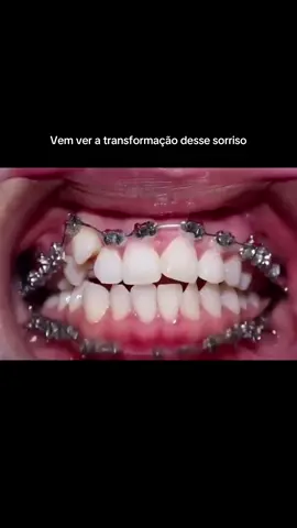 Evolução ortodôntica. Transformação  #ortodontia #sorriso #dentistaentiktok #fypage #transformação 