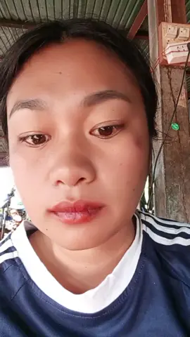 #สิว #ดีบอกต่อ #แพ้ง่ายใช้ได้ #แสบคัน #บวมแดง 