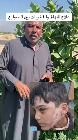 علاج للبهاق والفطريات بين الصوابع