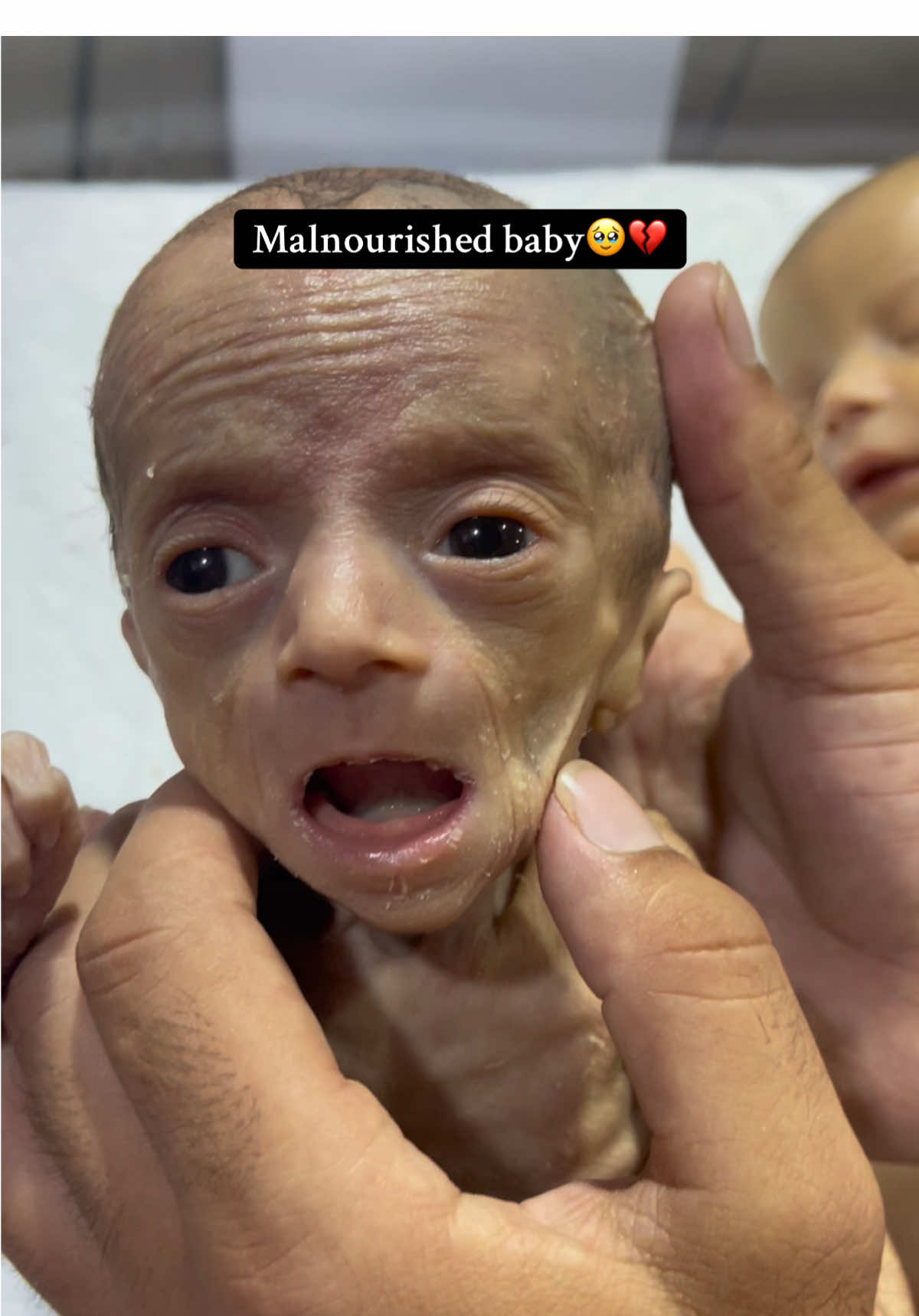 Extremely malnourishment baby😔💔 #malnutrition #malnourishment #prematurebaby #nicubaby 