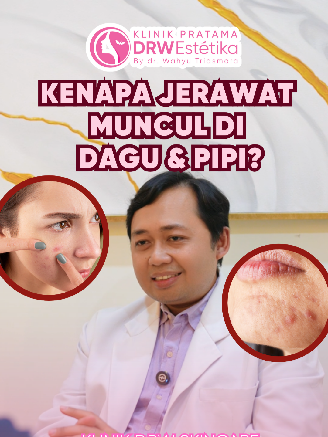 Jerawat sering muncul di dagu & pipi? Bisa jadi penyebabnya genetik, hormon, makanan, atau bahkan stres! Tapi tenang, setiap jerawat ada solusinya ✨ Di Klinik DRW Skincare, kamu bisa dapetin treatment tepat sesuai kondisi kulit dengan pengawasan dokter berpengalaman. Yuk treatment sekarang! Saatnya lawan jerawat dengan cara yang aman & efektif! #DRWEstetikaKlinik #KlinikDRWSkincarePurworejo #klinikdrwskincaremagelang #klinikdrwskincarekutoarjo #klinikdrwskincare