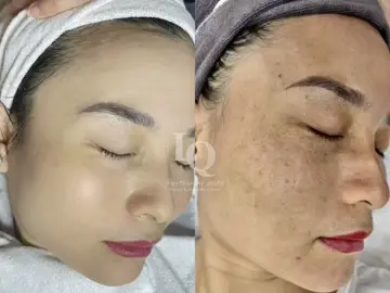 Cập Nhật da sạm nám #chamsocdamun#chamsocdanam #chamsocseo#lequynhspa#hocnghespa 