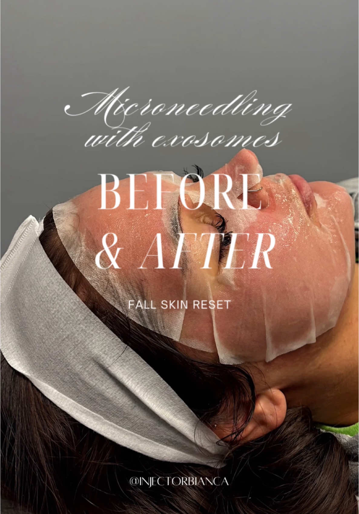 Microneedling + exosomes my favorite fall combo 🧛🏽‍♀️❤️  #medspa #nurseinjector #microneedling #columbusohio #exosomes 