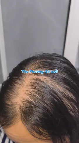 KH Thu Phương, 24 tuổi gặp phải tình trạng rụng tóc ở vùng đỉnh đầu do gặp vấn đề về rối loạn nội tiết tố và suy giảm estrogen khiến nang tóc yếu, mỏng, dễ rụng. Sau thời gian điều trị trực tiếp tại PK tình trạng rụng tóc của Thu Phương đã cải thiện. Chúc mừng em nhé ❤️ #CapCut #rungtoc #xuhuong #dieuly_bsdalieu#fpy 