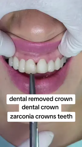 #zarconia #tooth #zarconia #teeths #dental #crowns #metal #foryoupage❤️❤️ 