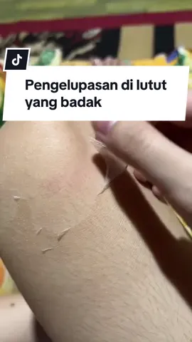 Serum peeling laushine pengelupasan di lutut #fyp #fypシ゚ #laushine 