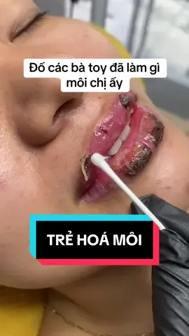 Đố các bà toy đã làm gì trên môi chị ấy #linhlamdepne #phunxamthammy #co2laser #76quangngai #xuhuong 