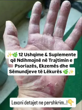 ✨🌿 12 Ushqime & Suplemente që Ndihmojnë në Trajtimin e Psoriazës, Ekzemës dhe Sëmundjeve të Lëkurës 🌿✨ 🥦 1. Peshku yndyror (Salmon, Skumbri, Sardele) – Omega-3 që qetësojnë inflamacionin. 🥑 2. Avokado & Vaji i Ullirit – hidratojnë dhe ushqejnë lëkurën. 🌰 3. Arrat & Farat e Linit – vitaminë E dhe yndyrna të shëndetshme. 🥕 4. Karotat & Batatët – beta-karoten për rigjenerim. 🥬 5. Spinaqi & Brokoli – burim i magnezit dhe antioksidantëve. 🍊 6. Agrumet – vitamina C për kolagjen dhe shërim të shpejtë. 🌿 7. Shafrani i Indisë – anti-inflamator i fuqishëm natyral. 💊 8. Vitamina D – e rëndësishme për ekuilibrin e imunitetit. 💊 9. Probiotikët – forcojnë sistemin tretës dhe ulin inflamacionin. 💊 10. Zinku , - Caji me gjethet e hithres – rigjeneron qelizat e lëkurës. ⚡ 11. Ormus Ar Monomatomik i Lëngshëm –suplement me densitet te larte  mineralesh bio te konsumueshme  që harmonizon qelizat, rrit rigjenerimin dhe ngre frekuencën e trupit. ⚡ 12. Argjend Koloidal – antibakterial natyral që pastron organizmin dhe mbron lëkurën nga infeksionet. 🌟 Mesazh Bioenergji77: Shëndeti i lëkurës është një udhëtim i brendshëm. Ushqimi, suplementet dhe frekuencat e dritës që i ofrojmë trupit bëhen ura mes shpirtit dhe materies.
