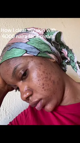 ✨ From dull to EndlessGlow! ✨ Clear, bright, glowing skin is possible 🌿💛 #EndlessGlowSkincare is here to give your skin the transformation it deserves. #SkincareRoutine #GlowUp #BeforeAndAfter #ClearSkinJourney  