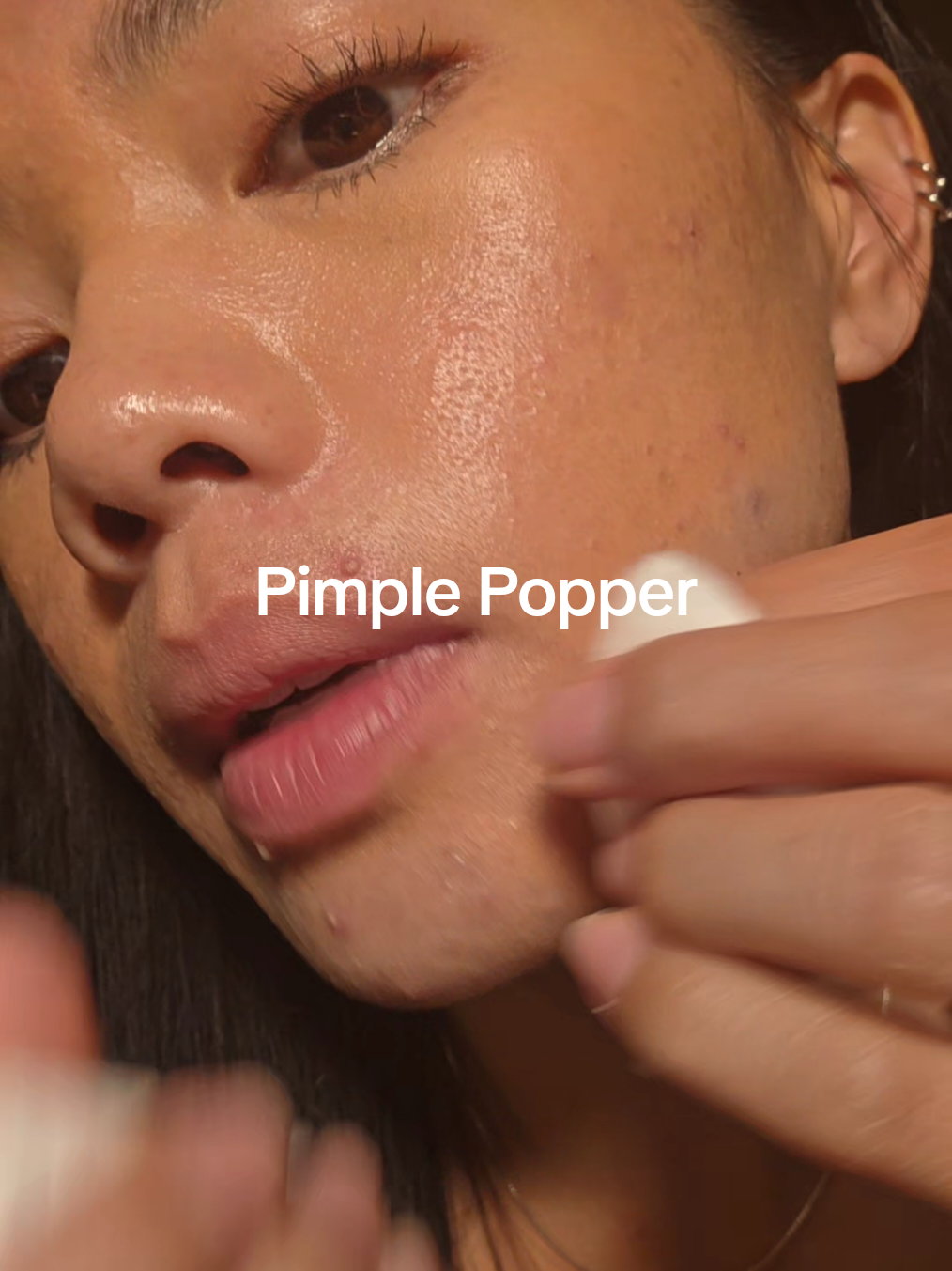 Another popping sesh 🌋 10 days till accutane  Where my pimple popping freaks at? #pimplepopper #pimplepopping #acne #hormonalacne #satisfying  
