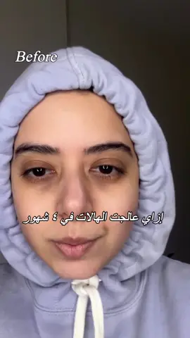 ⁨	⁨	٤ شهور كاملة من التجربة، وده كان التطور تحت عيني! النتيجة ما جاتش في يوم وليلة، بس مع الاستمرار فرقت فعلًا ✨ الكريم ده من Mary&May موجود حصريًا في ‪‬ ‪@Korea Shop ABC - EGYPT ‬ في City Stars Mall 🛍️⁩⁩ @Mary&May Official  @Mary&May Arabic 