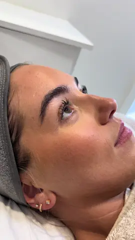 Smooth. Hydrated. Radiant. ✨ Our Facial Microneedling with Skin Boosters is designed to target: ✔ Fine lines & wrinkles ✔ Problematic / uneven skin ✔ Dry & dull complexion ✔ Sun damage 📸 Swipe to see the results! Notice how the lines around the mouth are visibly softened and the skin looks refreshed. 🌸 OCTOBER SPECIAL 🌸 Enjoy 20% OFF all facial microneedling treatments this month only! 📅 Limited availability – book now to reveal your glow. 💌 DM to reserve your spot or book online putting OFFER into the notes section ✨ #Microneedling #SkinBoosters #GlowingSkin #fyp  #BeforeAndAfter