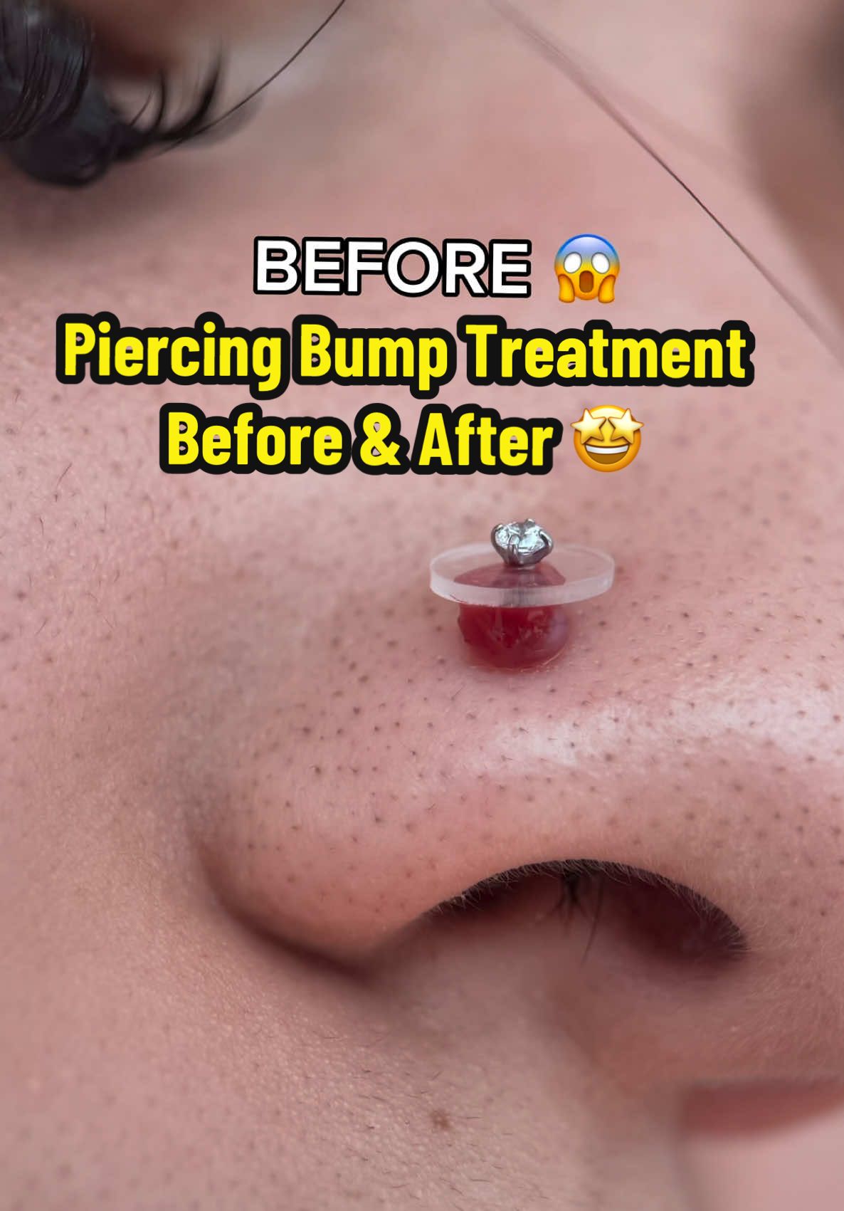 I didn’t have much hope for this piercing, but it proves anything is possible 🙌✨ using @Base Laboratories #fyp #healing #HealingJourney #piercing #viral 