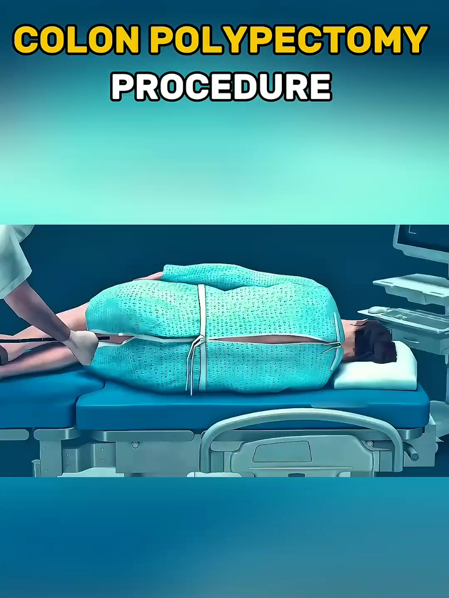 Colon polypectomy 3d animations. ever wondered how doctor remova polyps from the colon. #colonpolypectomy #HealthEducation #MedicalAwareness #RecoverySupport #SurgicalCare 