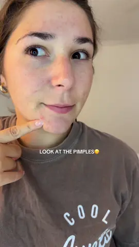 YALL WE FINNA GET OUR BRAINS ITCHED TOMORROWWWWWW I haven’t had a juicy pimple in tewwwww long I can’t wait for this pull    🔗 in store front under pimple patches🩹 @Peach Slices #peachslices #acnejourney  #pimplepatches #pimplepatch #acneproneskin 