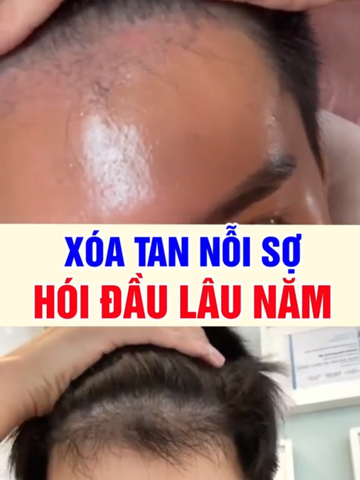 Xoá tan nỗi sợ hói đầu lâu năm #kichmoctoc #daugoiDHT #daugoikichmoctoc