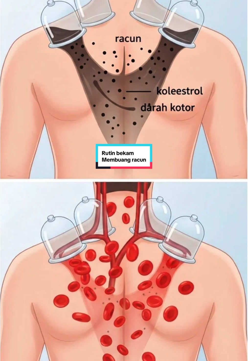 “Rutin bekam sebulan sekali bantu membuang racun dalam tubuh, melancarkan peredaran darah, dan membuat badan terasa lebih ringan serta segar.” ✨💆‍♂️#bekamsunnah #bekamwanita #bekamsehat #bekammalang #bekamangin 