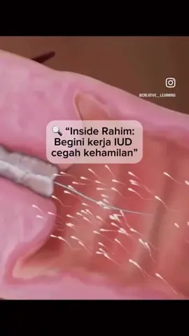 “Pernah kepo nggak, gimana sih ‘si kecil T’ alias IUD bisa ngusir sperma nakal biar nggak nyampe ke telur? 🤔✨” 📚 Edukasi : 	•	IUD itu kayak bodyguard mini yang nongkrong di rahim 🚨 	•	Dia bikin suasana rahim jadi ‘nggak ramah’ buat sperma → sperma jadi lemes, nggak bisa berenang marathon 🏊‍♂️💨 	•	Ada yang pakai tembaga (bikin sperma auto KO) 	•	Ada juga yang pakai hormon (bikin lendir serviks kental → sperma jadi nyasar, kayak main GPS error 😵📍) 	•	Intinya: telur tetap aman, nggak jadi ketemu jodohnya alias sperma ❌🥚 ⸻ ✅ Do & ❌ Don’t: ✅ Pasang IUD hanya lewat tenaga kesehatan 👩‍⚕️ ✅ Rajin kontrol sesuai jadwal biar posisi tetap oke ✅ Tanyakan dulu ke dokter kalau ada keluhan aneh ❌ Jangan coba pasang/cabut sendiri (ini bukan DIY project, Bun 😅) ❌ Jangan skip kontrol karena bisa aja geser posisi ❌ Jangan percaya mitos “IUD bisa jalan-jalan ke kepala” 🚫🙃 (hoax banget!) #fypシ  #fyppppppppppppppppppppppp  #pijatbayisukabumi  #kbiud  #bkkbn 