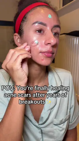 ✨ Healing my acne scars with vegan PDRN ✨ I’ve been using the @VT Cosmetics US PDRN 100 Essence + Capsule Cream and omg the difference 😍 My skin feels smoother, scars are fading + my barrier feels so much stronger. If you’ve got acne-prone skin, post-acne marks or textured skin — this duo is a game-changer 🙌 #acnescars #barrierrepair #skincarethatworks #pdrn #kbeautyskincare 