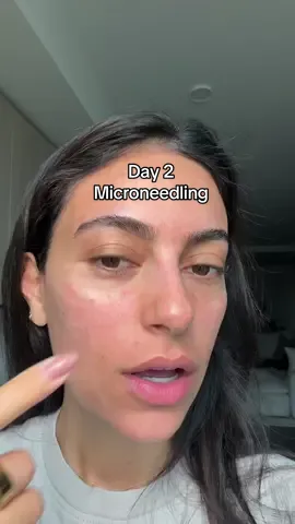 Day 2 after microneedling. I don’t know why I was so scared of this before 🤣 #microneedling #facialtreatment #microneedlingface #skintok #fy 