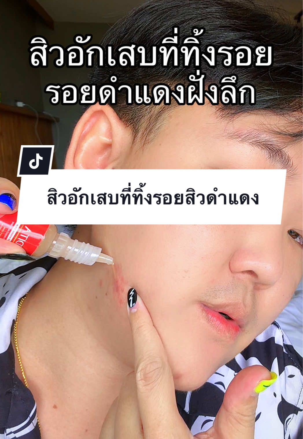 @โซว'ชอบฟังเพลงเศร้า  สิวอักเสบที่ทิ้งรอยสิวดำแดง #ตัวลดรอยสิวเมดิต้า #รอยสิว #เมดิต้า #ของมันต้องแชร์ #tiktokshopmallบอกต่อ 