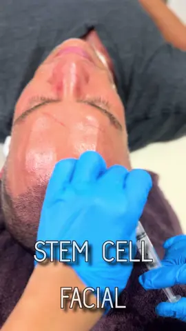 STEM CELL FACIAL is a regenerative treatment using Stem Cells and their growth factors to stimulate skin repair, boost collagen and improve elasticity, texture and tone. It works at a cellular level, often delivered vía microinjections. #stemcells #skinrejuvenation #collagen #elasticity #texturedskin 