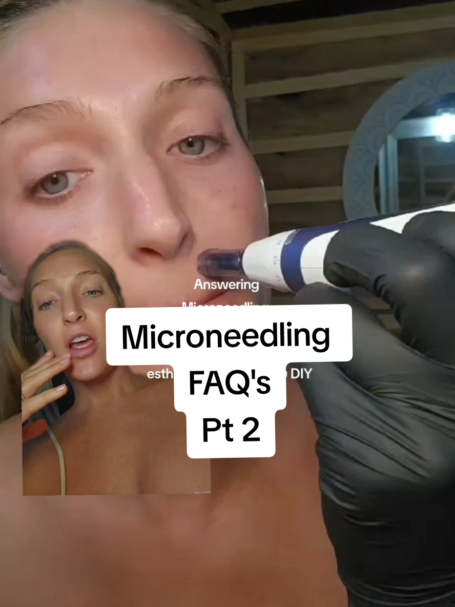 find everything you need to microneedle at home in my bio ❤️