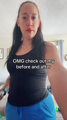 Panniculectomy update!! Checkout my results!!!#panniculectomy #MomsofTikTok #yiannashapewear @YIANNA INC 