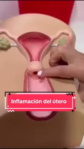 ¿Por qué se puede tener el cuello del útero inflamado? 🤷🏼‍♀️  A veces las inflamaciones del cuello uterino no tienen que ver con algo grave, no te espantes… Puede ser algo tan sencillo como el roce con el 🍆 de tu pareja. ¡Te cuento! 💜  ¿Te punza, arde, duele o sientes una sensación de inflamación? Acude a consulta, es mejor prevenir y consulta lo que está sucediendo. Mándame mensaje y haz una cita. 💬 